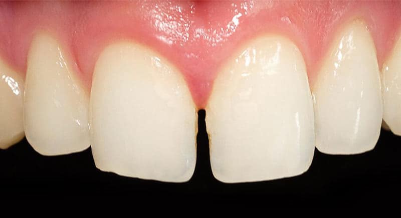Zahnfarbene Füllungstherapie Vorher